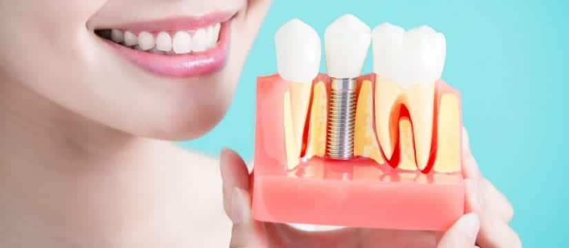 Dental Implant Hygiene Care
